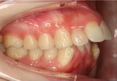 Thời Gian Niềng Răng Hô Có Lâu Không?